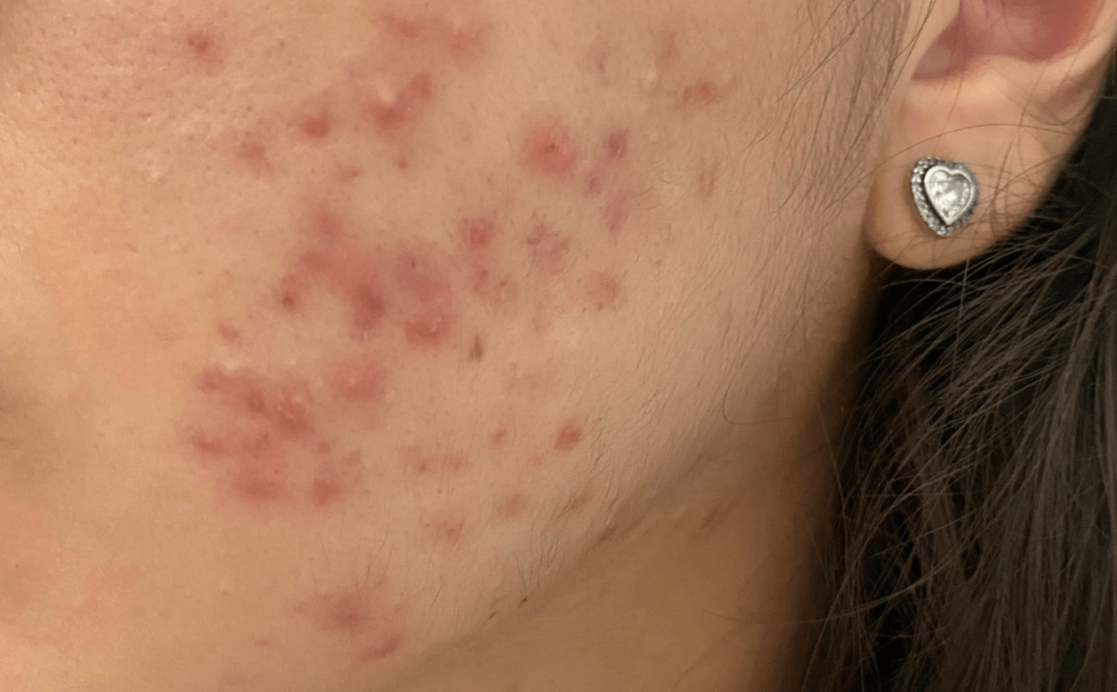 pele com acne inflamada