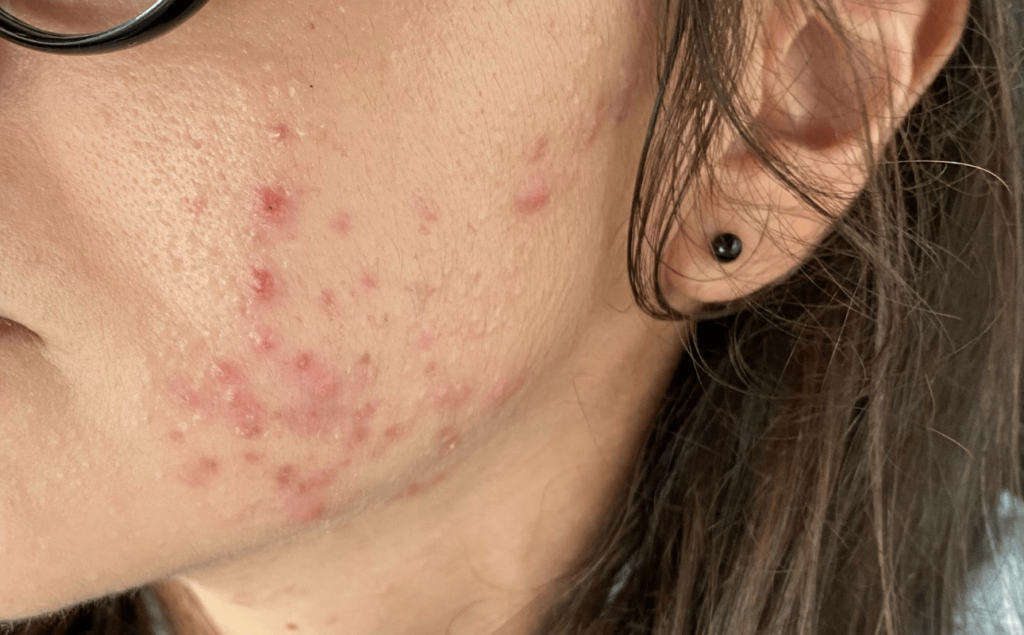 pele oleosa com acne inflamada e tratamento com roacutan