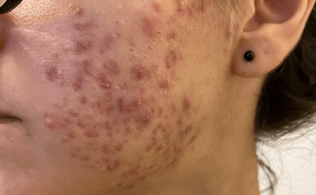 pele com acne grave inflamada e tratamento com roacutan