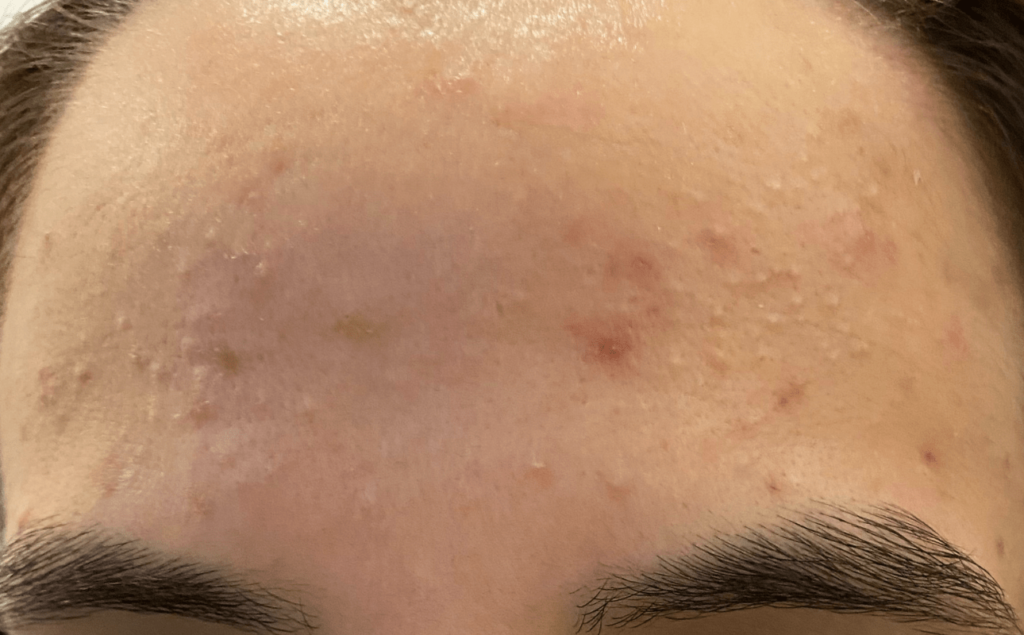 pele com acne na testa e tratamento com roacutan