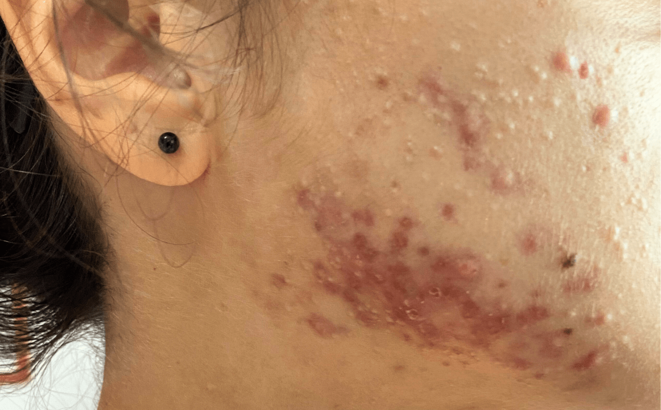 Tratamento para acne grave com Roacutan