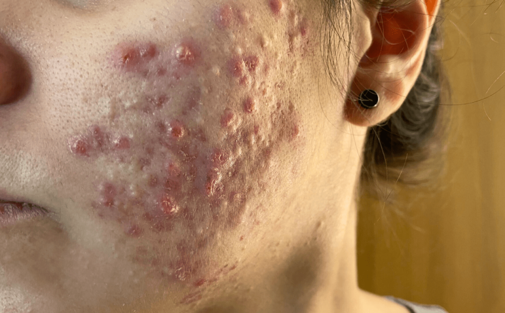 1 mês de roacutan - acne inflamada