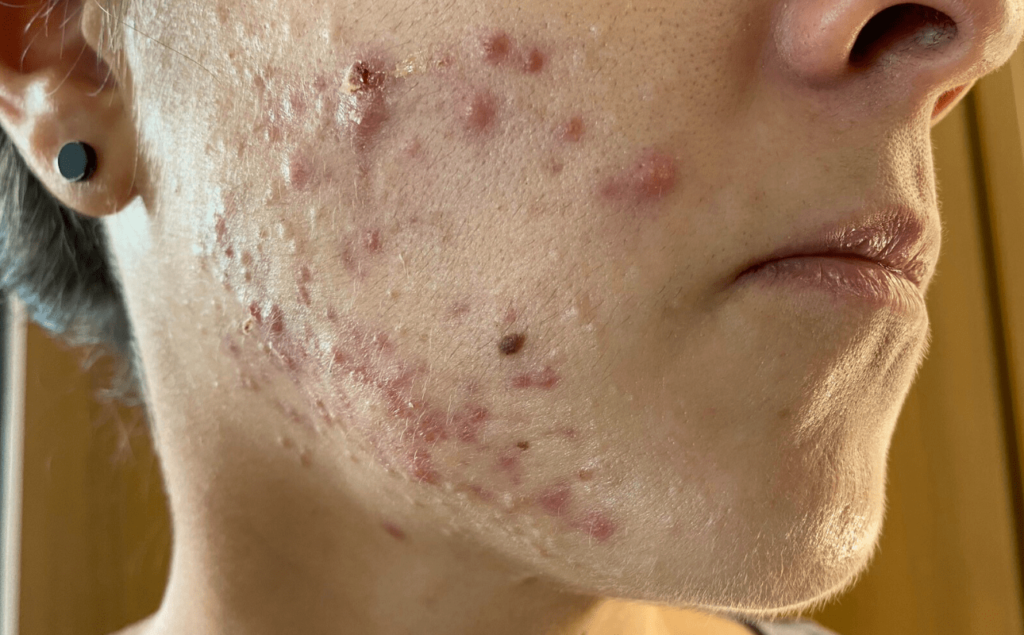 1 mês de roacutan - pele acneica inflamada