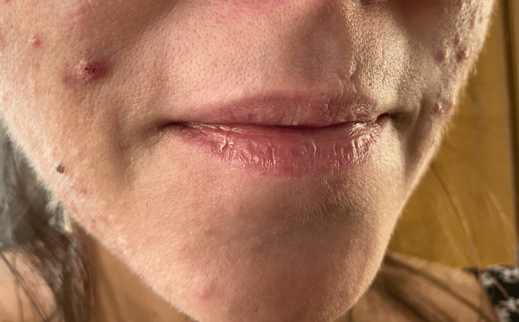 1 mês de roacutan - pele dos lábios ressecada