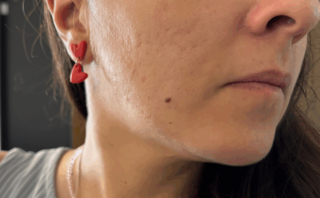 1 ano após o Roacutan