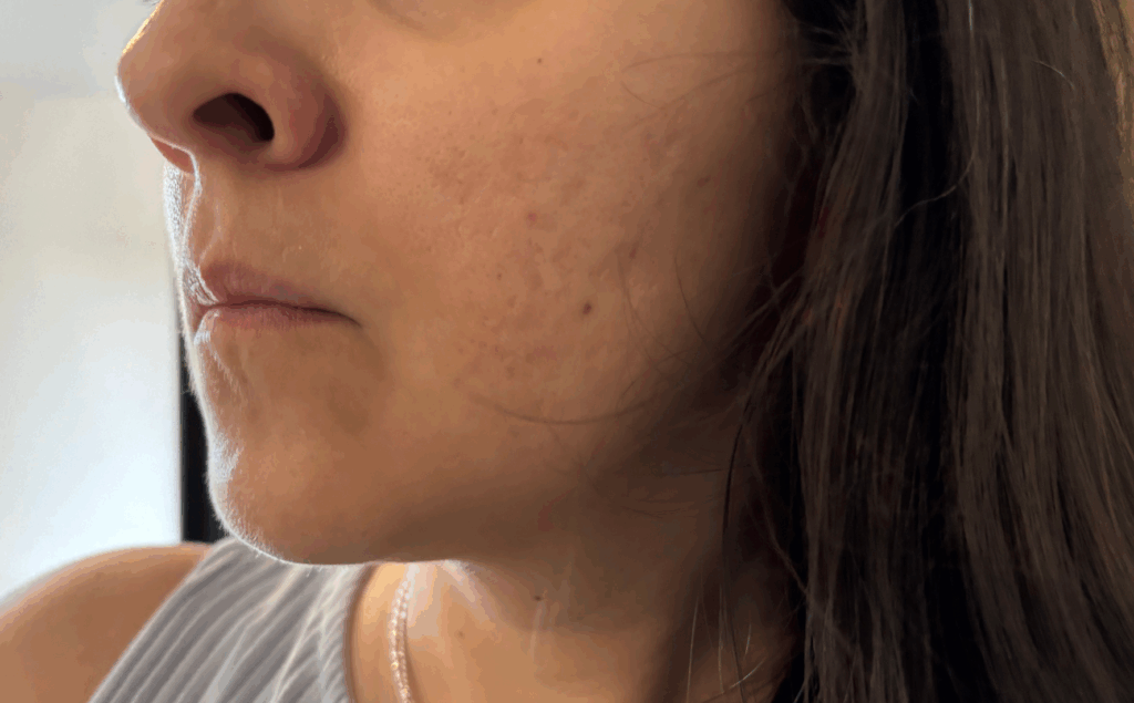 1 ano após o Roacutan